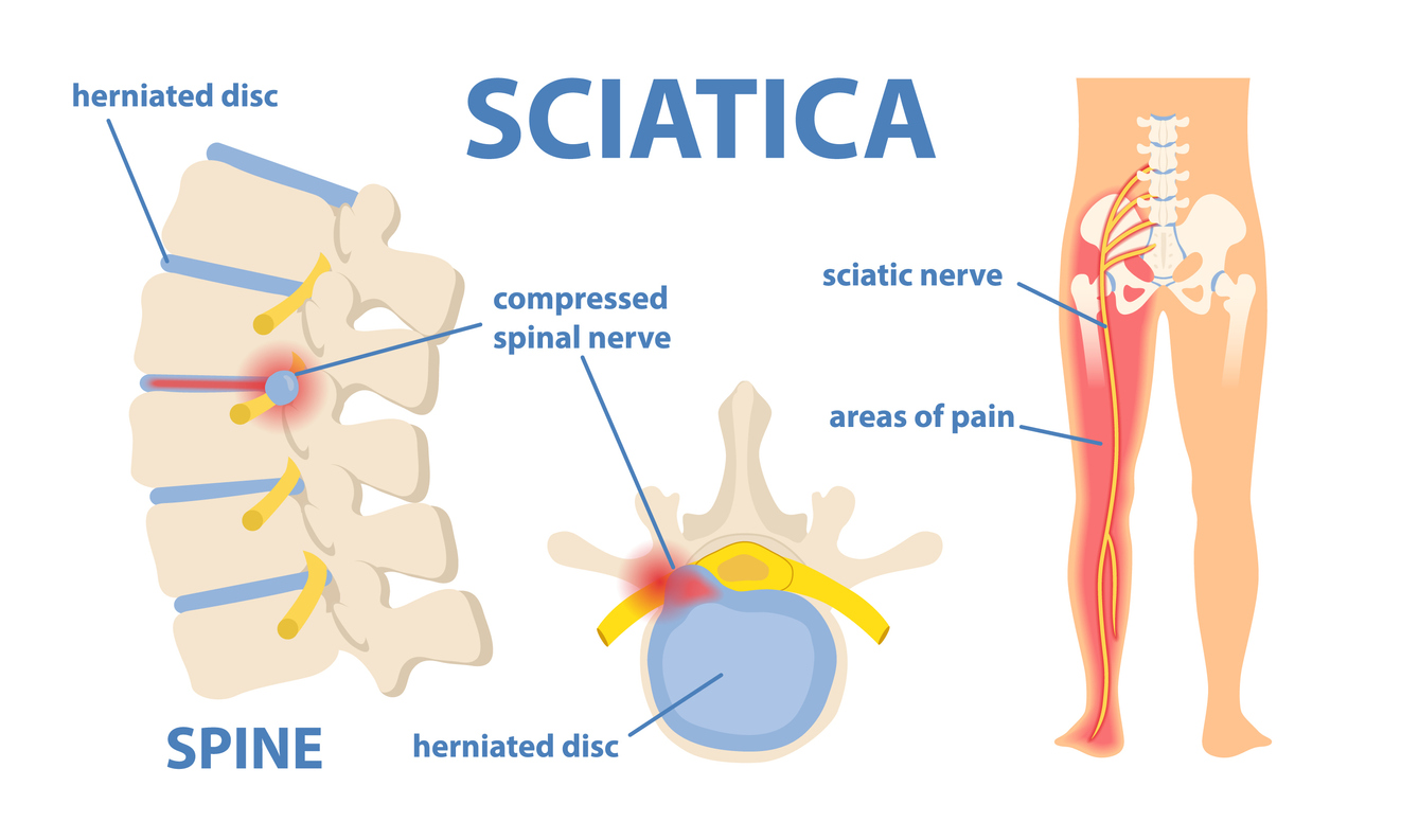 hijama for sciatica pain